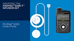 Inserting the Sure-T Infusion Set with the MiniMed 630G Insulin Pump