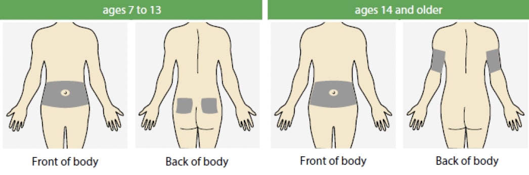 insertion locations for Guardian Sensor 3