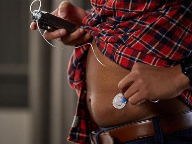 Close up of MiniMed 780G pump and Extended infusion set on body'