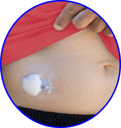 sensor and transmitter on abdomen