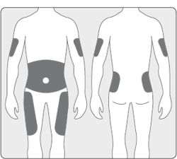 i-Port Advance™ injection port Recommended application sites