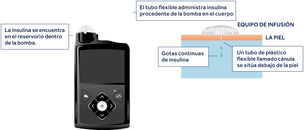 ¿Cómo funciona la bomba de insulina?