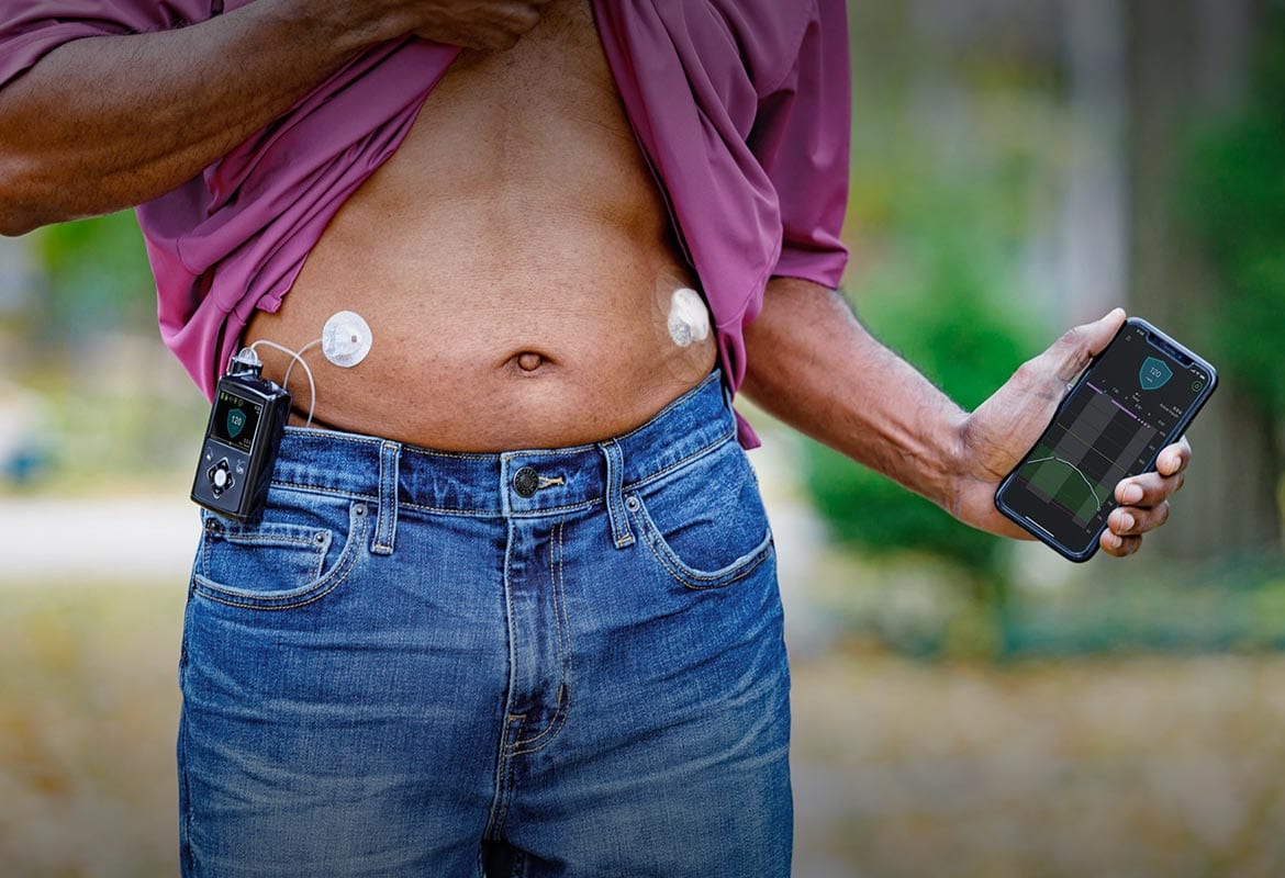 ¿Funciona Eversense con la bomba de insulina en tándem?