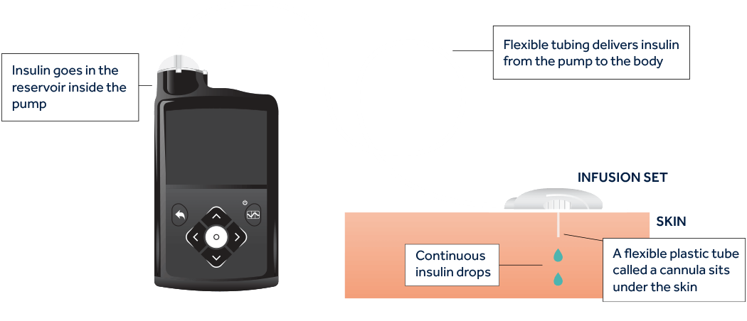 How does an insulin pump work?