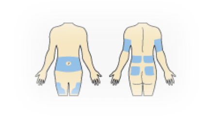 Infusion Set Insertion Locations