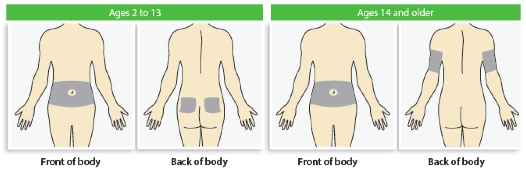 Guardian™ 3 Sensor Glucose Sensor Insertion Locations