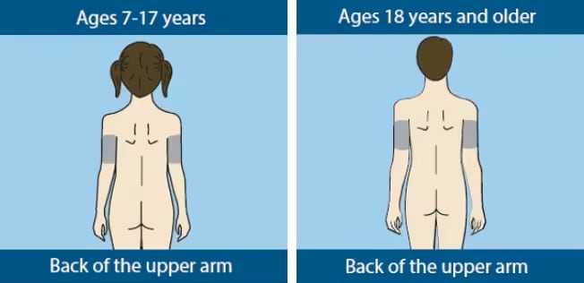 Guardian™ 4 Sensor - Glucose Sensor Insertion Locations
