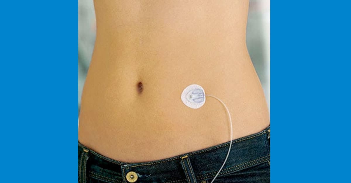 Infusion Sets For Insulin Delivery Medtronic Diabetes