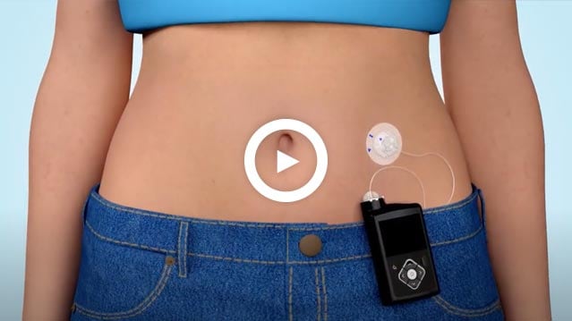 What is insulin pump video