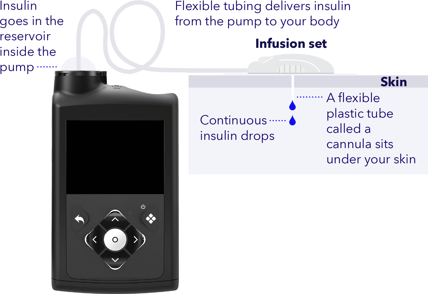 How does an insulin pump work?