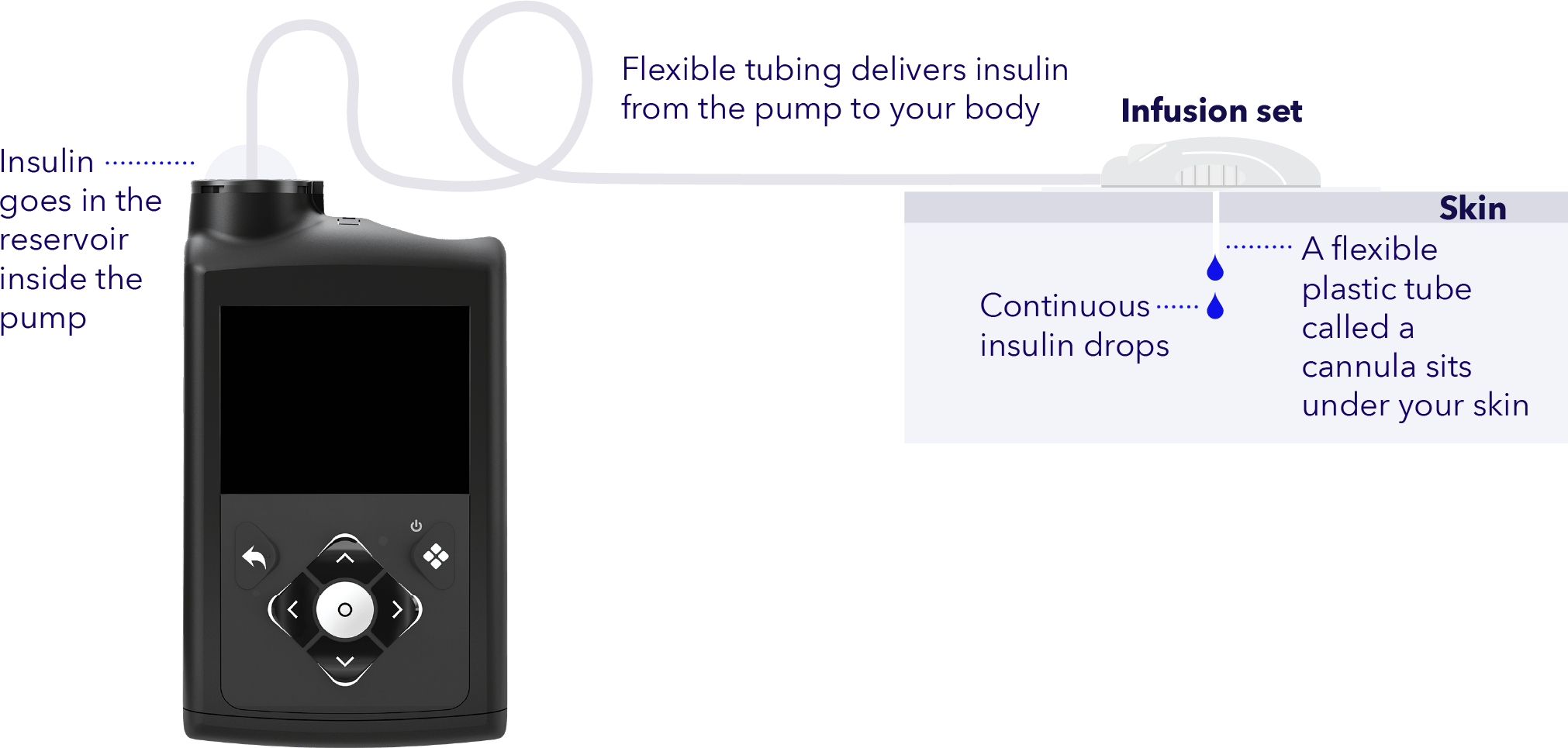 How does an insulin pump work?