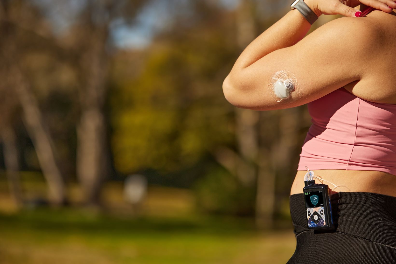 Insulin pump and CGM on a body