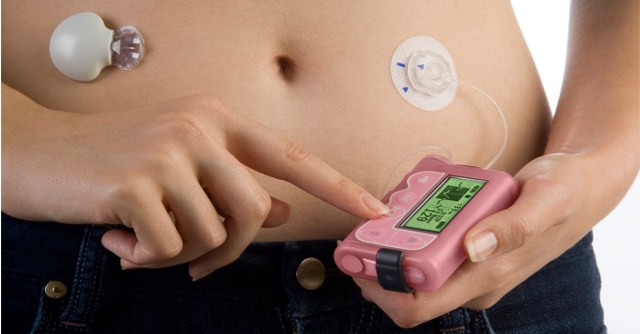 Insulin Pump And Continuous Glucose Monitor